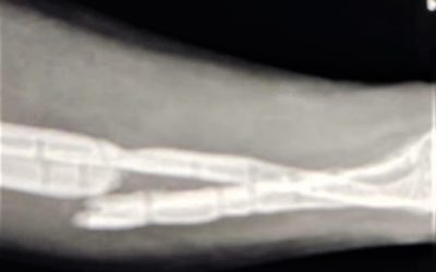 Caso complejo de fractura bifocal de cúbito y radio