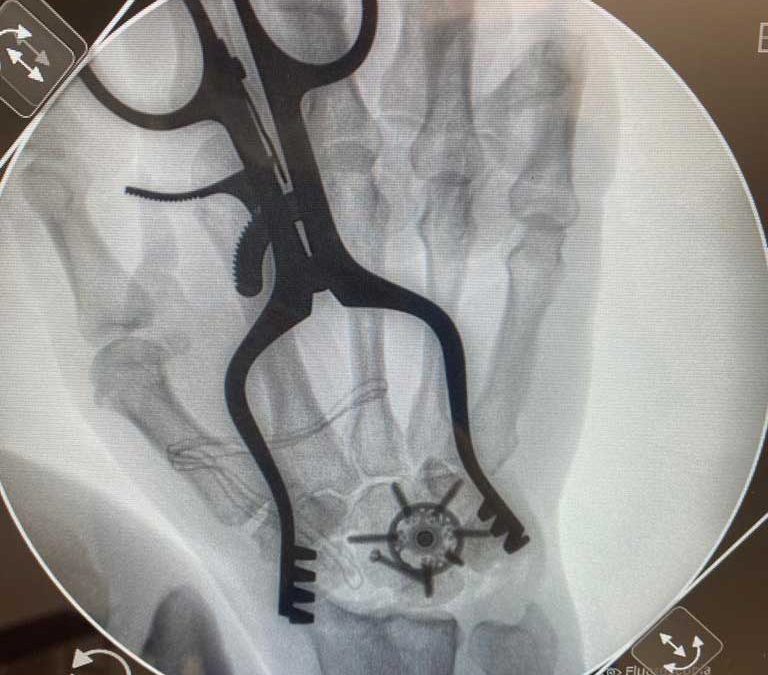 Artrosis de carpo (mano o muñeca): Qué es, causas y soluciones