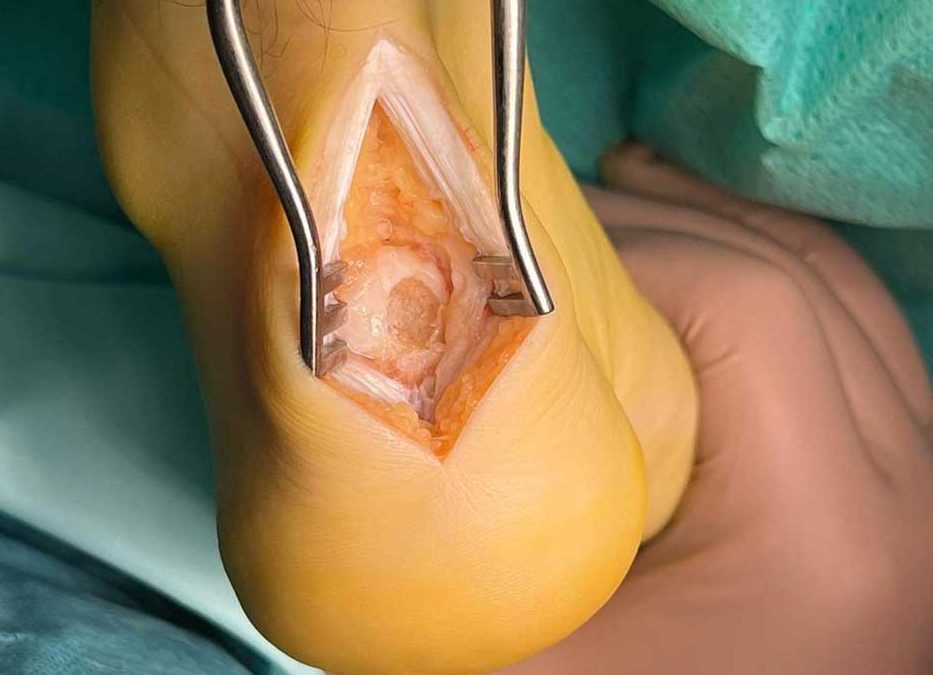 Qué es un quiste sinovial: un caso en el Aquiles