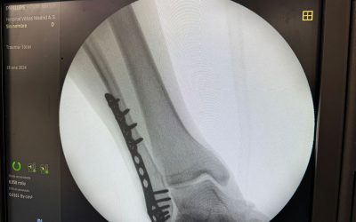 Encondroma de peroné: síntomas, diagnóstico y tratamiento