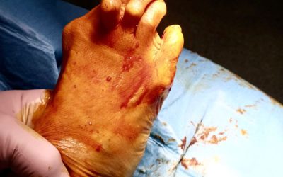 ¿Qué es el hallux valgus o juanete?