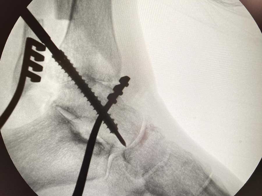 Artrodesis o prótesis de tobillo: qué opción es mejor para cada paciente