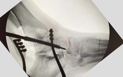 Caso de artrodesis de tobillo aplicado con innovación para artrosis avanzada