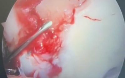 Uso de malla acelular de colágeno para lesión acetabular