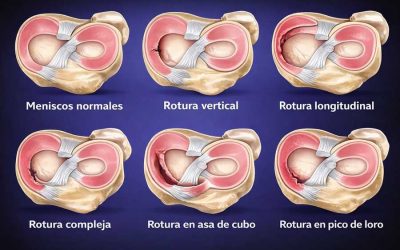 Rotura de menisco en asa de cubo: tratamiento y recuperación