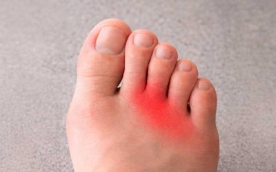 Neuroma de Morton: qué es, síntomas y tratamientos
