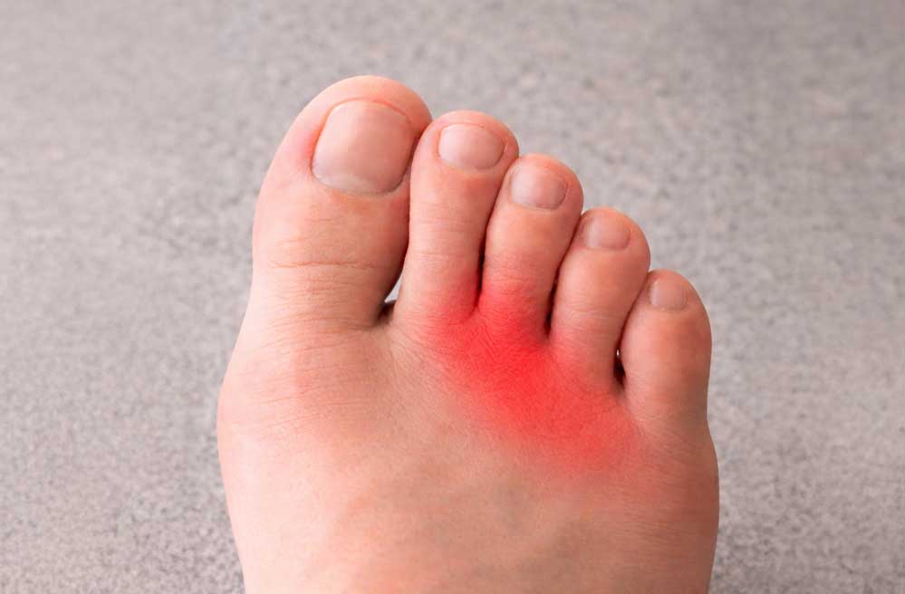 Neuroma de Morton: qué es, síntomas y tratamientos