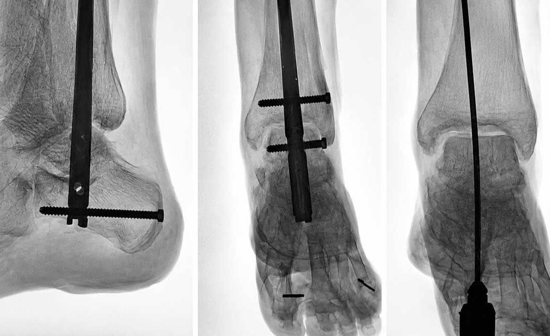 Artrodesis tibiotalocalcánea (TTC) para el dolor de tobillo