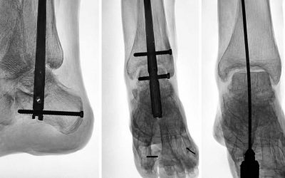 Artrodesis tibiotalocalcánea (TTC) para el dolor de tobillo