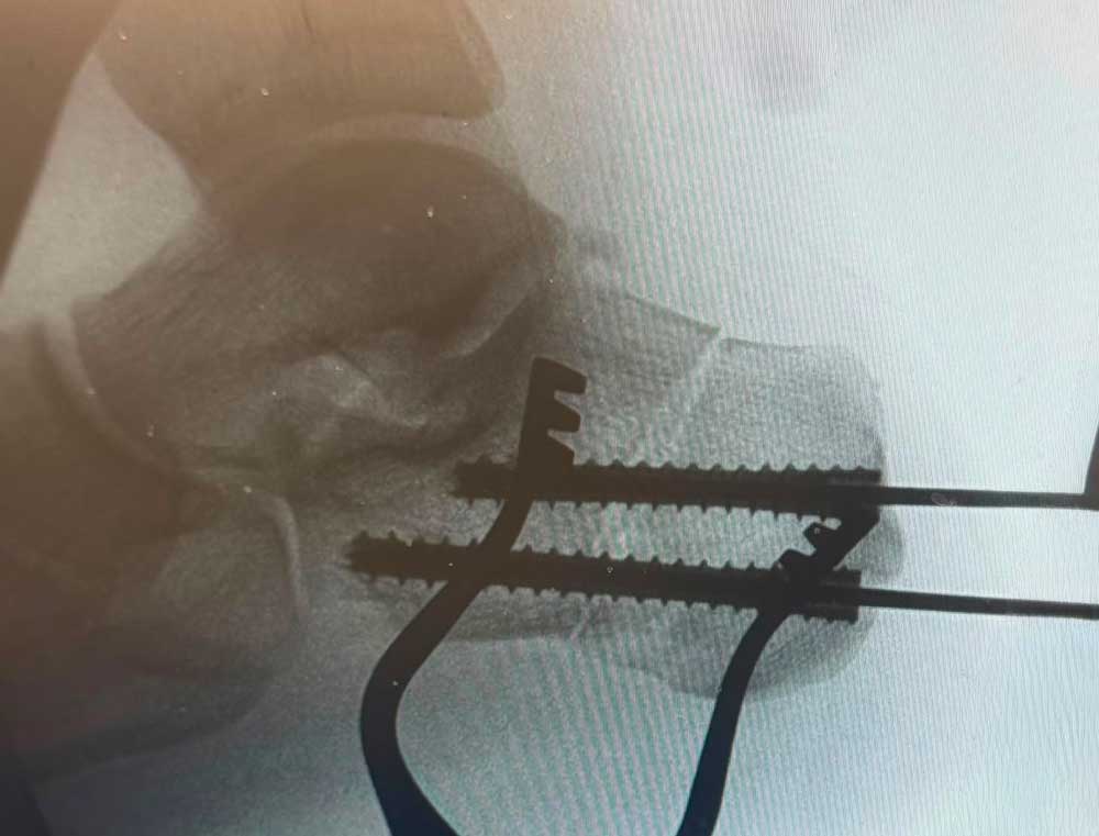Osteotomía de calcáneo fijada con dos tornillos canulados de 7,5 milímetros