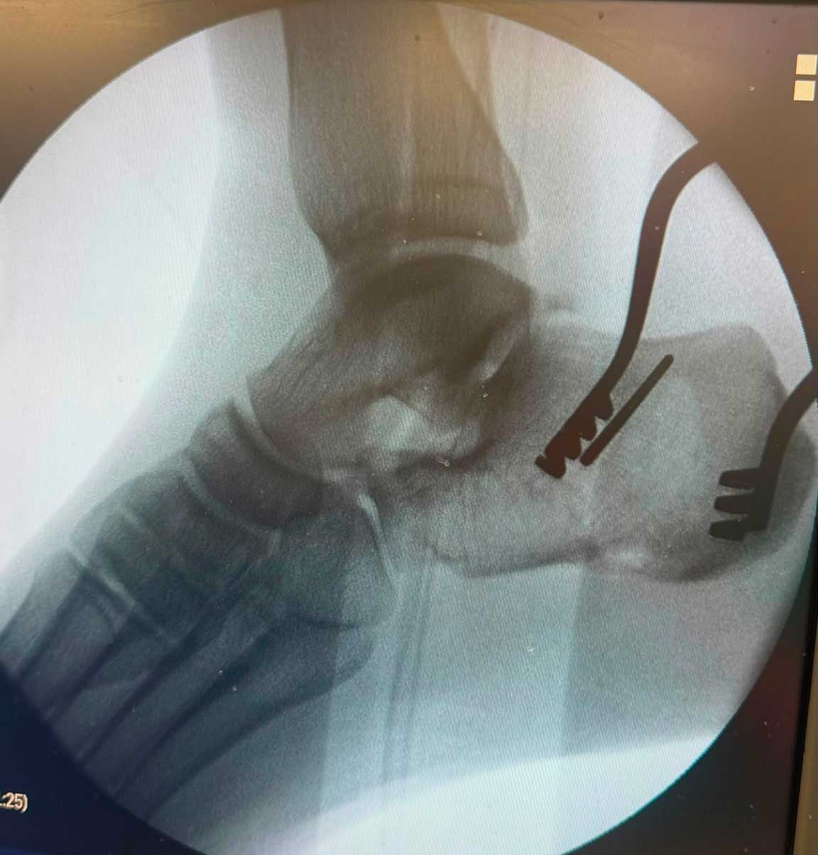Control radioscópico lateral del pie antes de la osteotomía de calcáneo en un caso de síndrome de Müller-Weiss