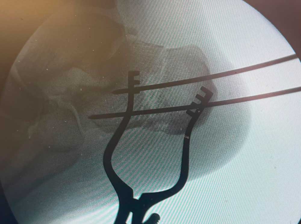 Osteotomía de calcáneo con agujas guía colocadas bajo control radioscópico