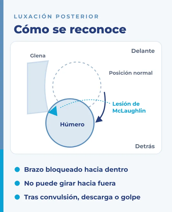 luxacion-posterior-de-hombro-mclaughlin-dr-david-cimas